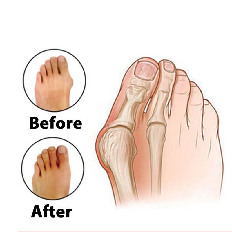 Pelurus Kaki Korektor Jempol Kaki Bunion Hallux Valgus Mmisen