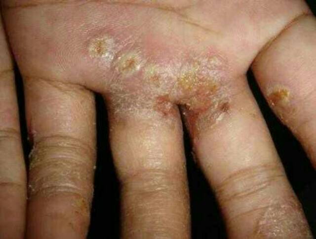Obat Scabies Kudis Kurap Gudig Tungau Kutu Air Panu Racikan Dokter Shopee Indonesia