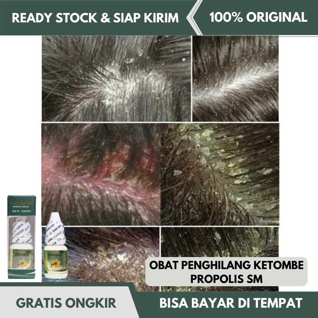 Obat Ketombe Berkerak - Ketombe Parah - Pembasmi Ketombe - Obat Ketombe - Obat Penghilang Ketombe De