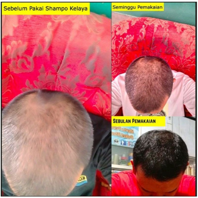 (FREE HAND SANITIZER) ORIGINAL Kelaya Hair Treatment Shampoo and Hair Tonic/ Shampo Botak Rontok Penumbuh Rambut