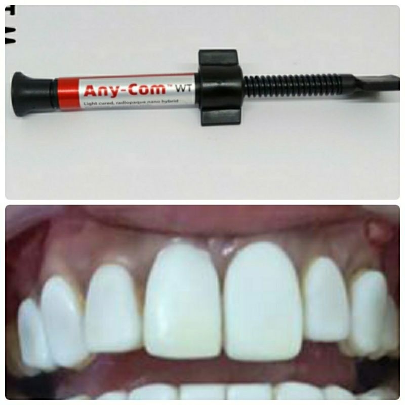 COMPOSITE ANY COM WT / LEM TAMBAL GIGI / LEM VENEER ATAU GIGI KELINCI