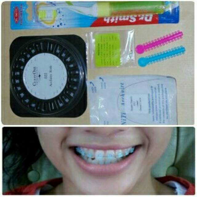 Paket Behel Permanen keramik ClassOne