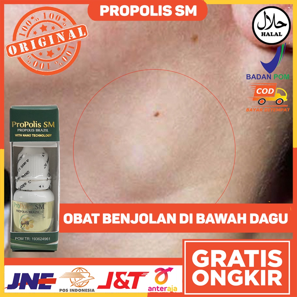 Obat Benjolan di Bawah Dagu - Penghilang Benjolan - Menghilangkan Benjolan - Penghancur Benjolan - T
