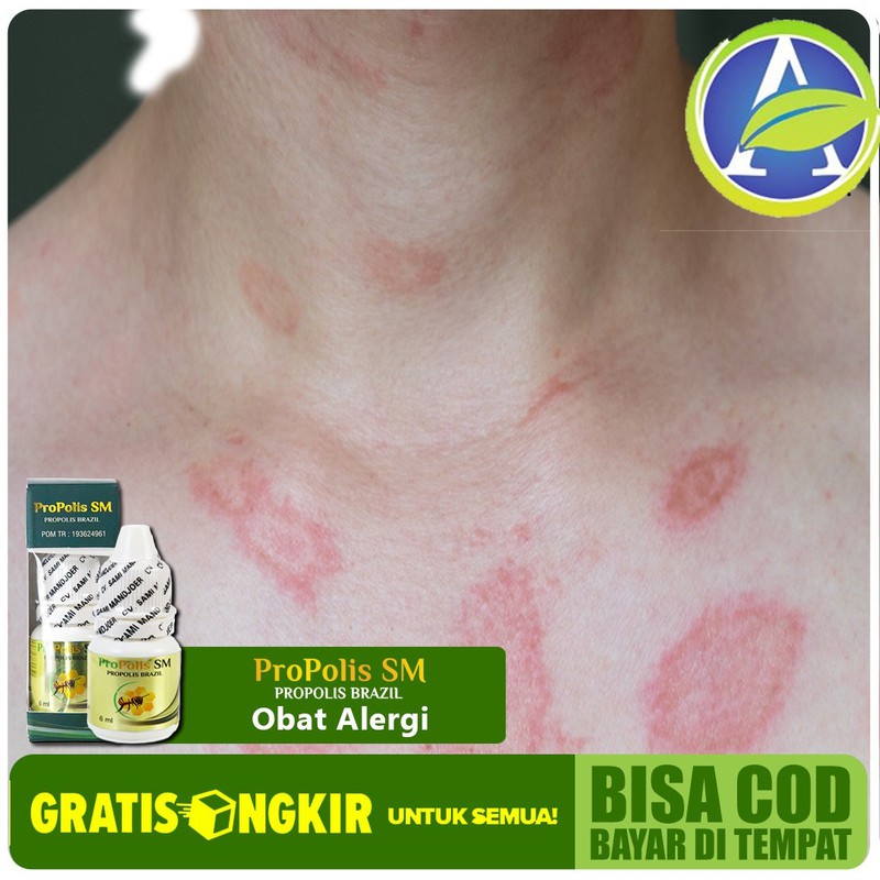 Obat Alergi Bersin, Batuk Anak, Selangkangan, Tangan, Bisul, Alami Herbal PROPOLIS SM Herbal