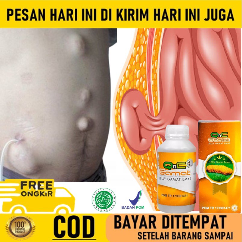 Obat Hernia Turun Berok - Obat Turun Berok Pria / Wanita - Obat Turun Peranakan - Obat Usus Turun