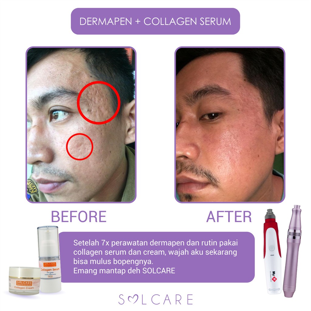 serum untuk acne scar