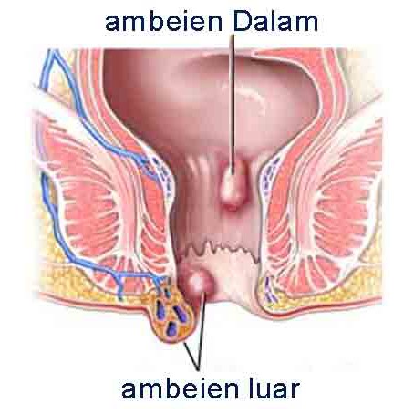 Obat Ambeien Fase 4 Obat Anus Ada Benjolan Obat Keluar Darah Segar Saat Buang Air Besar Shopee Indonesia