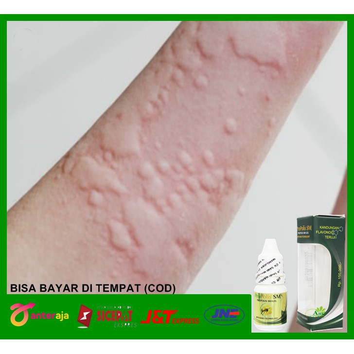 Obat Alergi Dingin, Biduran, Kaligata, Gatal Gatal, Flu, Bersin Bersin, Hidung Gatal - Propolis SM