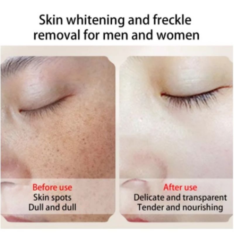 Cindynal obat cream Penghilang flek hitam salep krim pemutih wajah bekas jerawat Bruntusan flex melasma pigmen whitening freckle cream