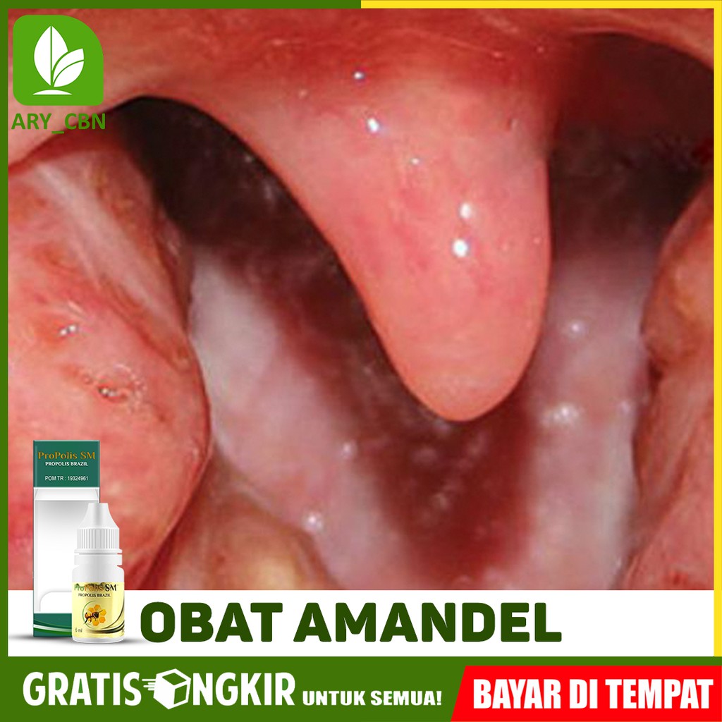 

Obat Amandel Anak Herbal, Amandel Bengkak Akut Kronis Herbal Propolis SM Brasil Bisa COD Di Cirebon