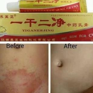 Jamur kulit Eksim Yiganerjing Salep Cream Herbal Terbukti Ampuh