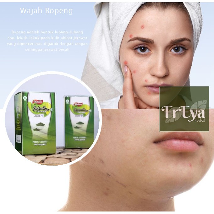 OBAT PENGHILANG BOPENG, OBAT BOPENG, OBAT BEKAS JERAWAT (BISA COD)