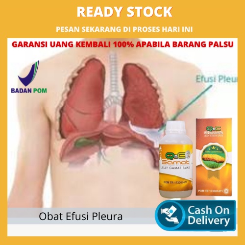 Obat Herbal Efusi Pleura, Penumpukan Cairan Pada Paru Paru, Edema Paru, Tb Paru, Bronkopneumoia, Bro