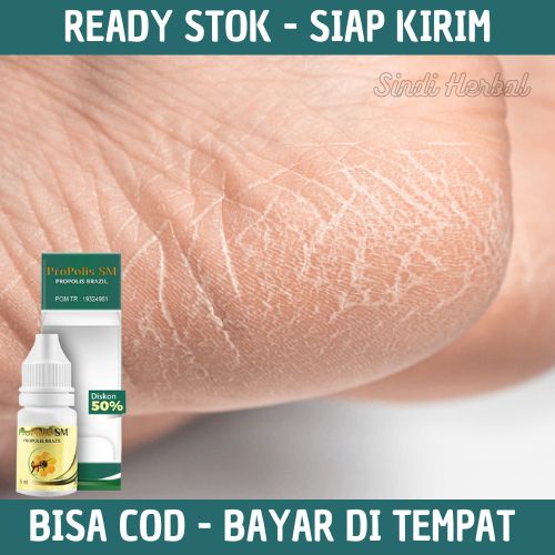 Obat Kapalan Kaki - Obat Kapalan - Obat Kapalan Tangan - Penghilang Kapalan Kaki - Pembersih kaki Ka
