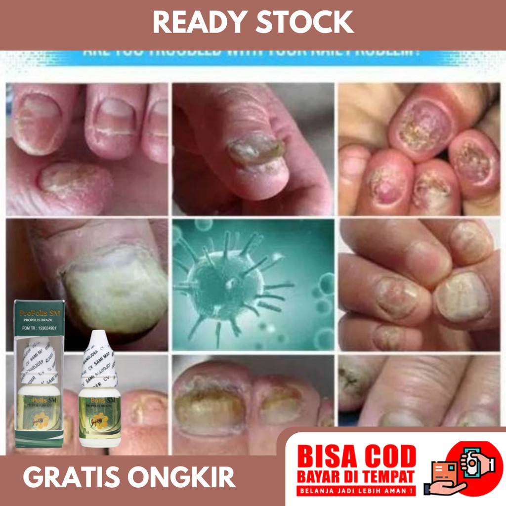 Obat Jamur Kuku, Kuku Jempol Rusak Dan Bau, Jamur Kuku Kaki, Pembersih Kuku, Infeksi Kuku, Kuku Kaki