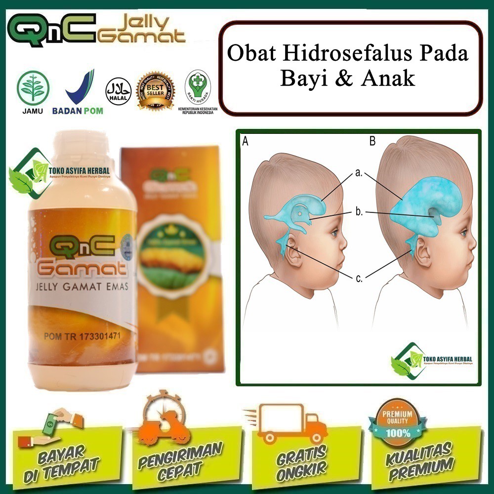 Obat Untuk Penyakit Hidrosefalus Pada Bayi / Anak 100% Herbal, Obat Hidrosefalus No Efek Samping