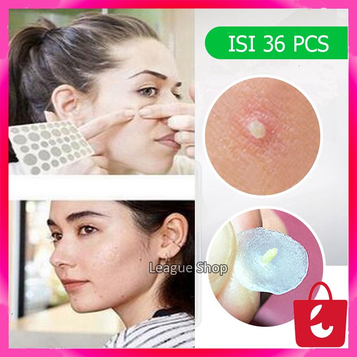 [Ready Stok] Sticker Jerawat Plaster Jerawat Obat Jerawat Batu  Bruntusan Patch Pria Wanita