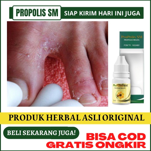 Obat Rangen Kaki, Salep Kutu Air Di Sela Jari Kaki, Obat Alami Gatal Di Sela Jari Kaki, Mengobati Ja
