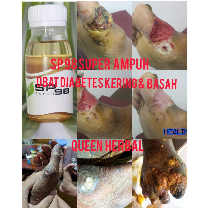 

OBAT DIABETES HERBAL ALAMI SUPER AMPUH