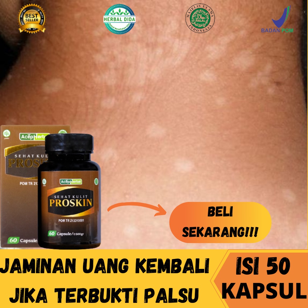 Obat Panu, Obat Kulit Panu, Obat Anti Panu & Jamur,  Mengobati Panu, Obat Kulit Panu an, Obat Jamur 