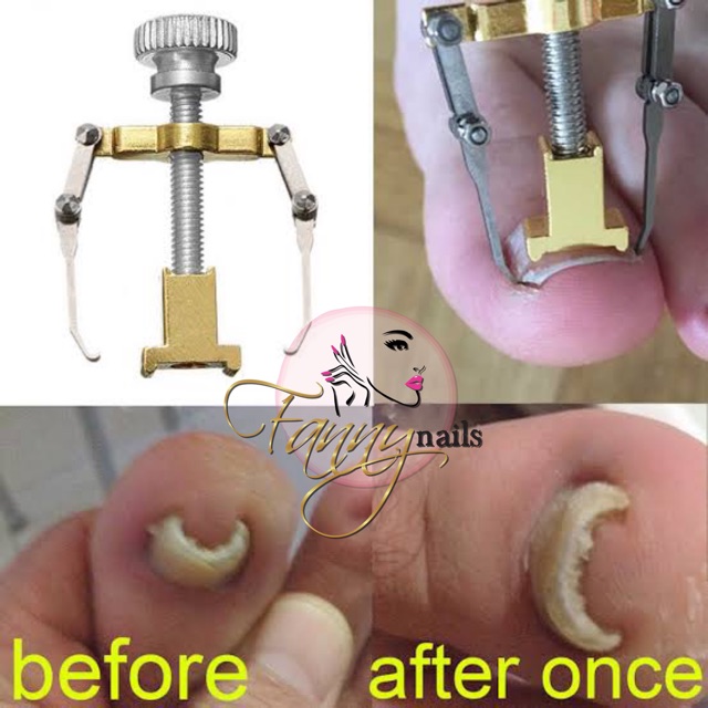 Alat Korektor kuku kaki cantengan / toe nail ingrown pedicure
