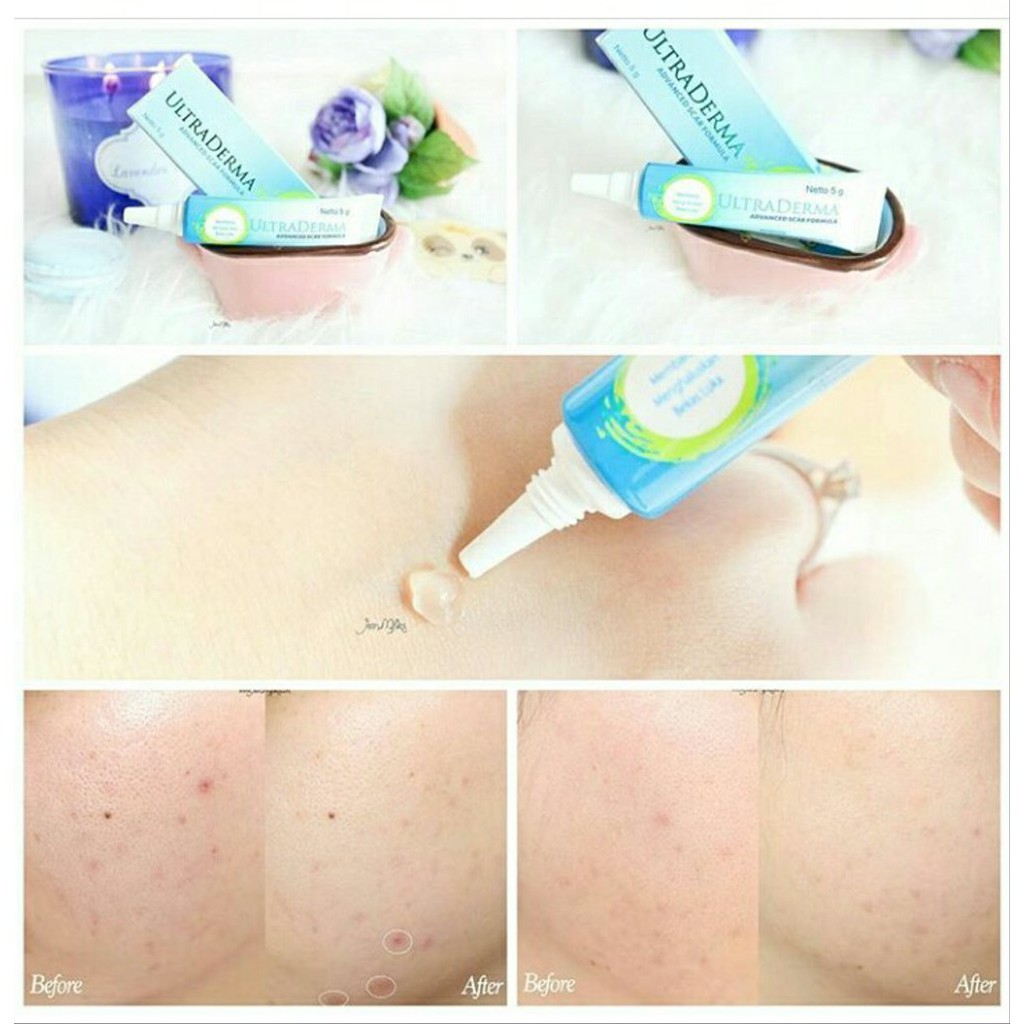 Ultraderma Advanced Scar / Skin Formula Penghilang Bekas Jerawat, Luka, Operasi, Keloid - 5gr