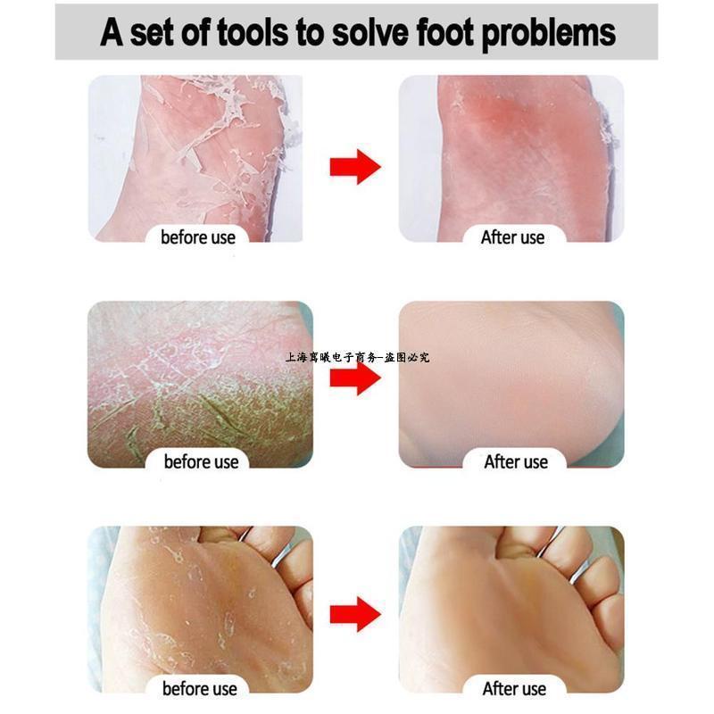 Kikir Amplas kaki untuk mengikis kulit mati kaki pecah jadi mulus parutan telapak kaki Alat Perawatan Kaki Manicure Pedicure Foot Care Scrubber Buah Kikir Kaki Kalus Baja Tahan Karat Profesional Putih Pengikis Pedikur Kulit Mati Alat Penghilang untuk Kaki