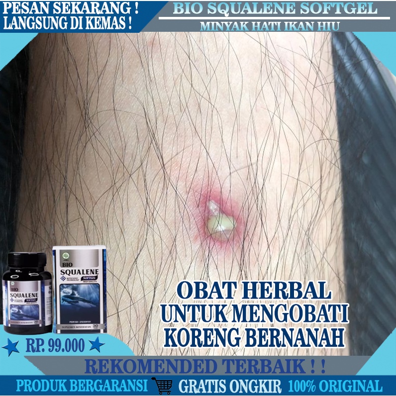Obat Luka Bernanah, Obat Luka Koreng Bernanah & Bengkak, Obat Luka Gatal Bernanah, Obat Herbal Luka 