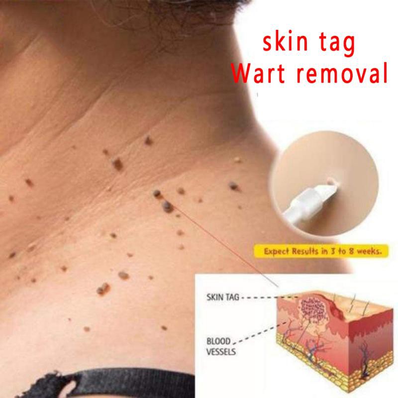 [100% Efektif] Obat Penghilang Tahi Lalat Obat Kutil Obat Kutil Kelamin Skin Taq Remover 10 ml