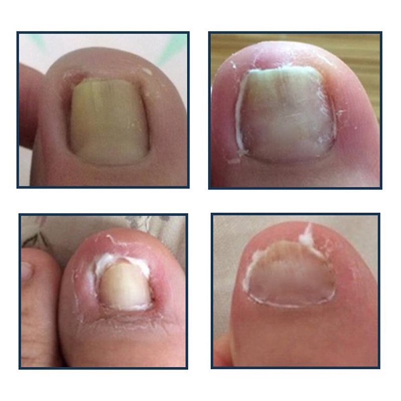 Alat Koreksi Kuku Kaki Tumbuh Ke Dalam Paronychia