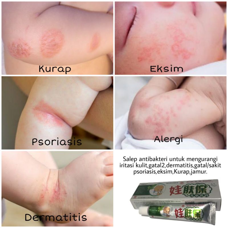 WaFuBao SALEP HERBAL CINA UNTUK GATAL ALERGI KURAP EKSIM BAYI / ANAK