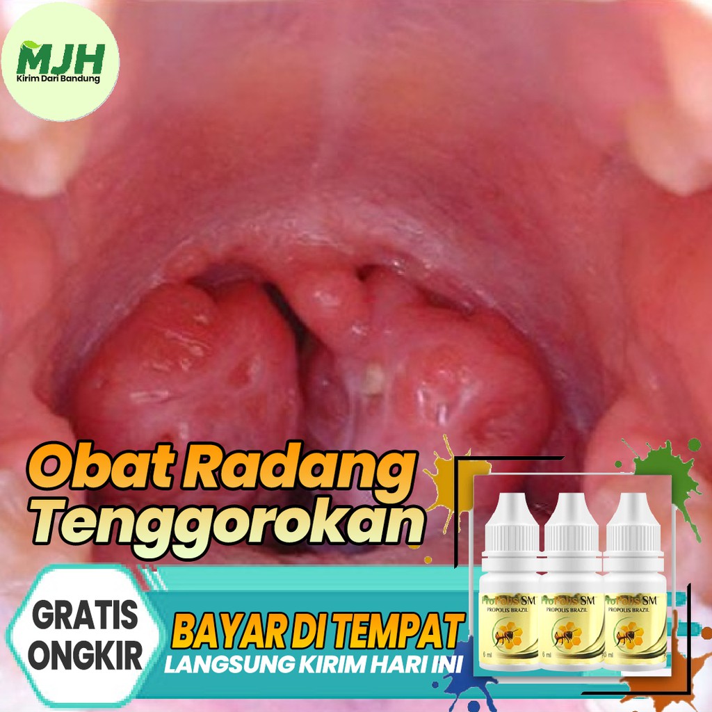 Obat Radang Tenggorokan Infeksi Tenggorokan Amandel Bengkak Parah Menahun Brazilian Propolis SM