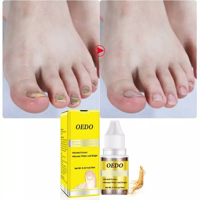 OEDO ESSENTIAL OIL perawatan jamur kuku