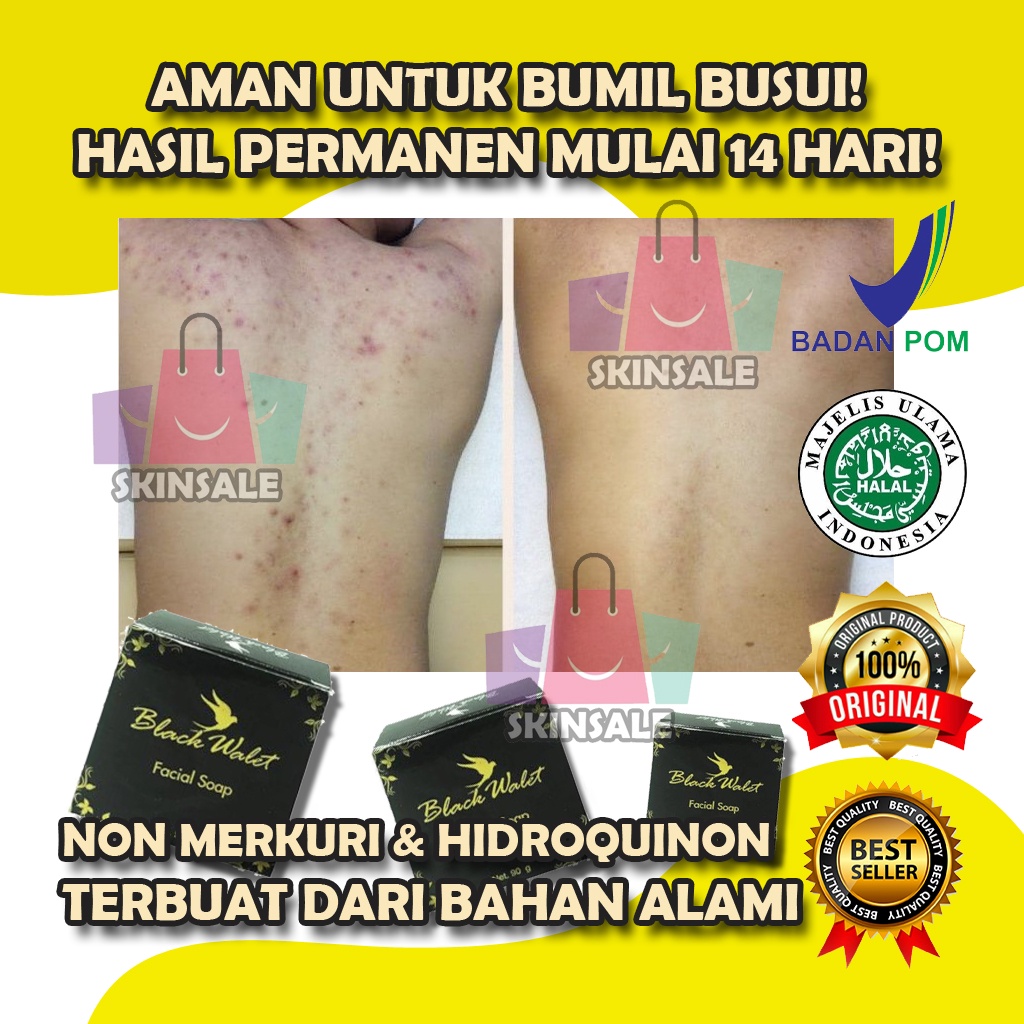 WALET SOAP SABUN JERAWAT PUNGGUNG OBAT JERAWAT PUNGGUNG SABUN JERAWAT UNTUK PUNGGUNG PENGHILANG JERA
