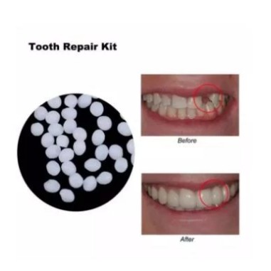 Temporary Tooth Repair Kit / Denture Adhesive / Lem Gigi / Gigi Palsu