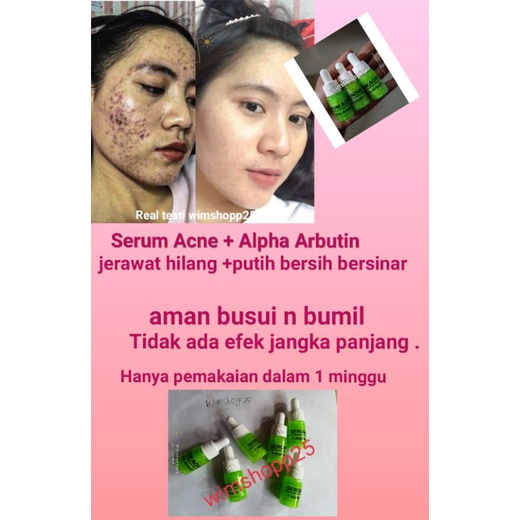 SERUM ACNE/JERAWAT+ ALPHA ARBUTIN