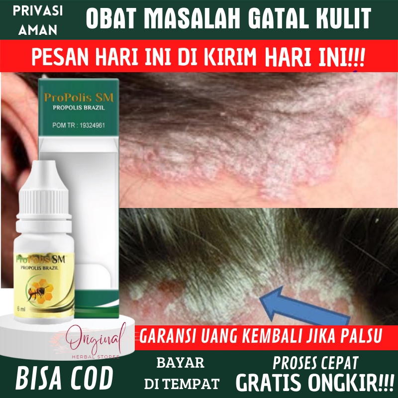 Obat koreng kepala, Obat ketombe berkerak, Obat Ketombe menahun, Obat tetes keteombe parah, Obat her