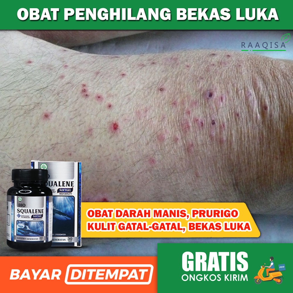 Obat Budug Santri Korengan Scabies Darah Manis Bekas Luka Bernanah BIO SQUALENE MINYAK HATI IKAN HIU