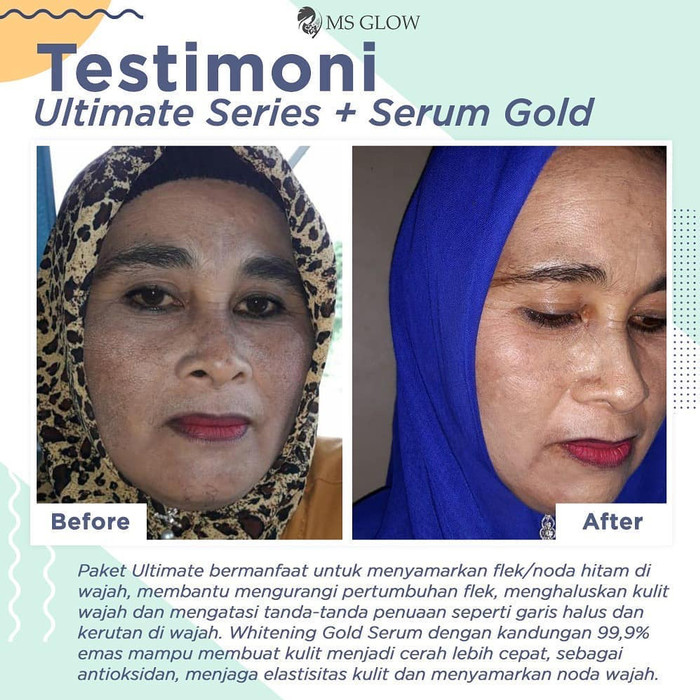 MS Glow Serum Gold | Whitening Gold Serum MSglow Ori Original