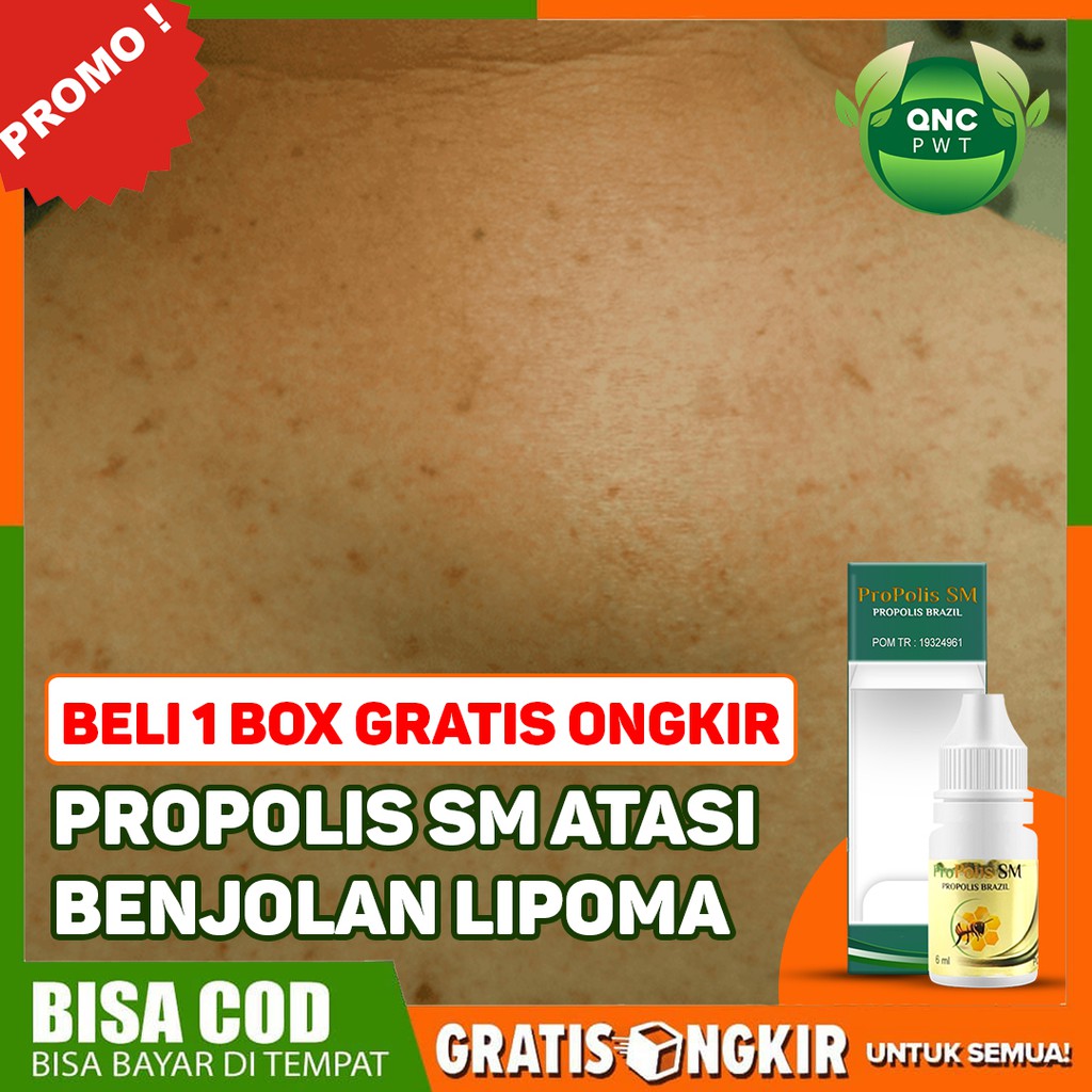 

Obat Benjolan Lipoma - Kelenjar Tiroid - Tiroid Bengkak - Benjolan Di Leher Propolis SM Kota Solo