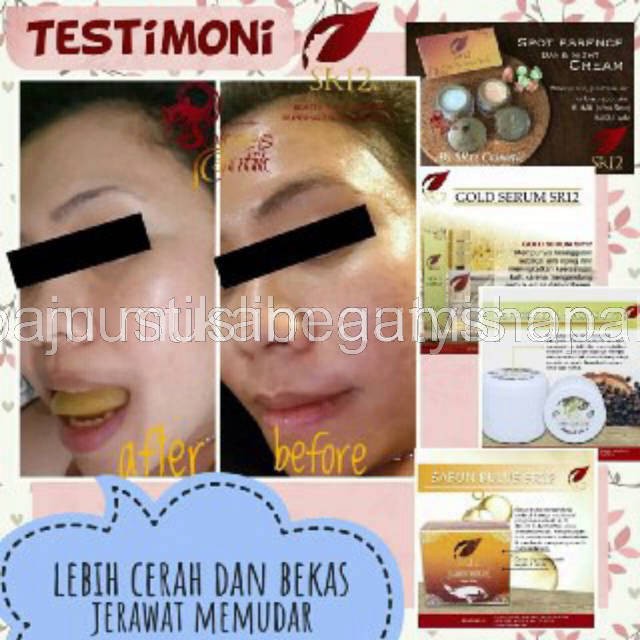 SPOT ESSENCE CREAM SR12 - TUMPAS BEKAS JERAWAT , FLEK HITAM &amp; NODA WAJAH