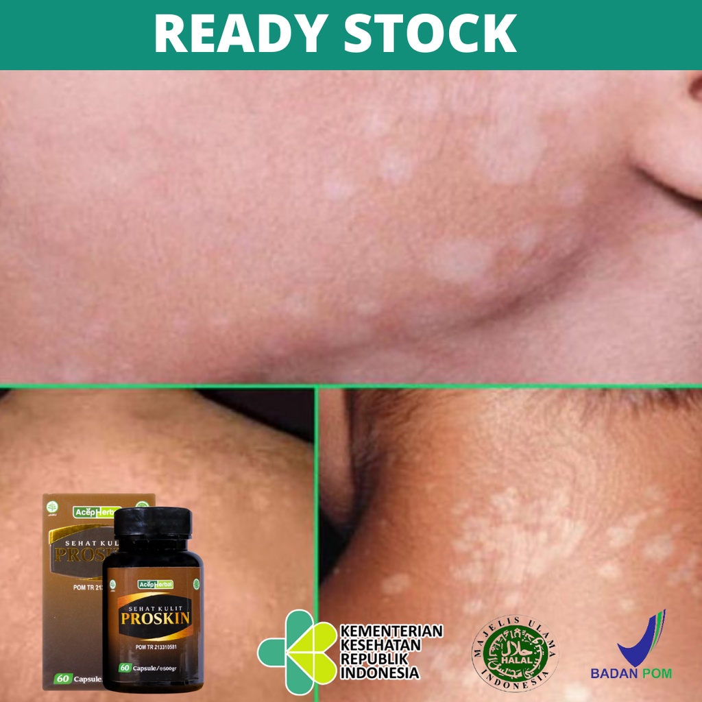 Obat Penghilang Panu, Penghilang Panu di Wajah, Leher, Punggung, Obat Panu Disertai Gatal Parah, Oba