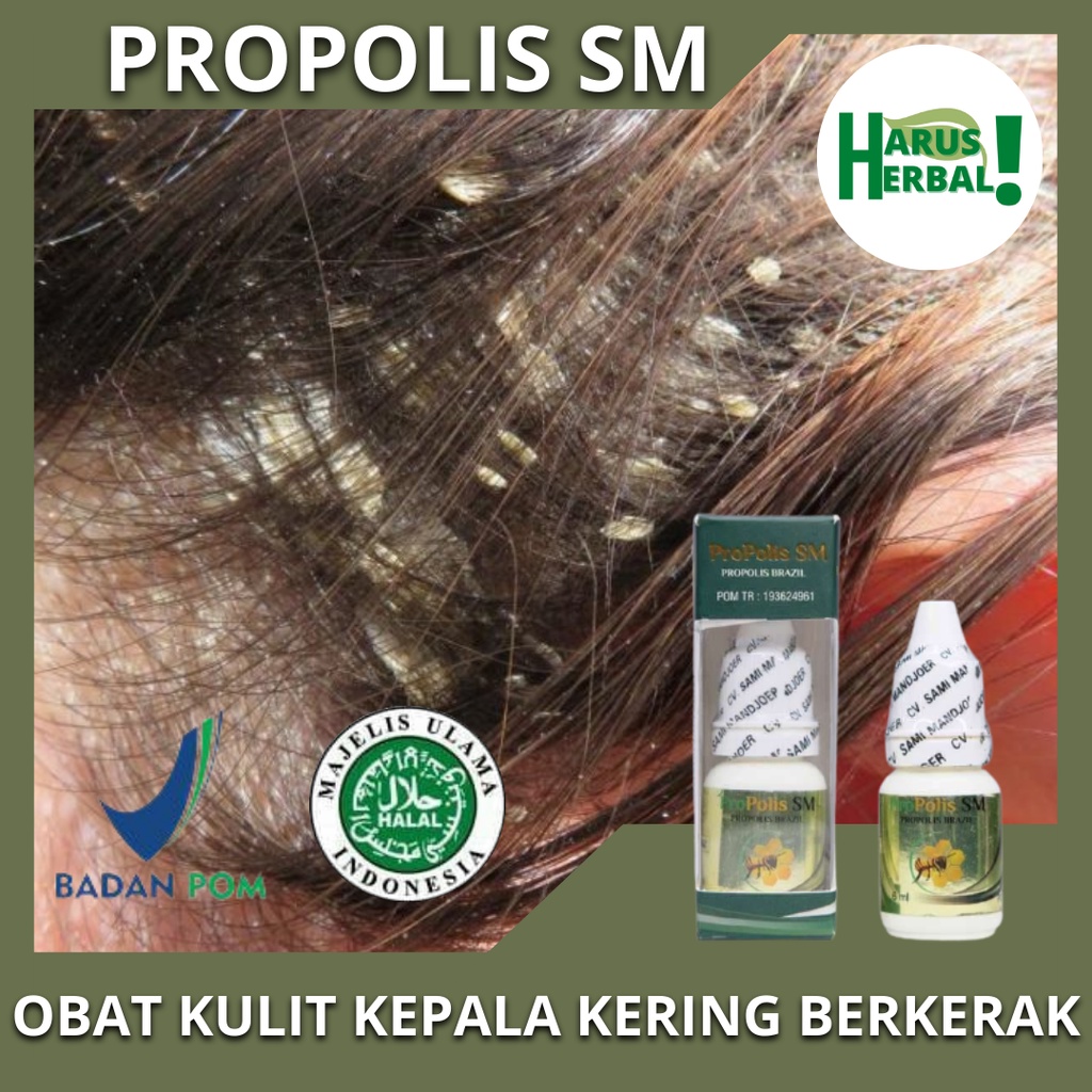 PROPOLIS SM Obat Kulit Kepala Berkerak, Obat Psoriasis, Obat Kulit Kepala Kering, Obat Kulit Kepala 