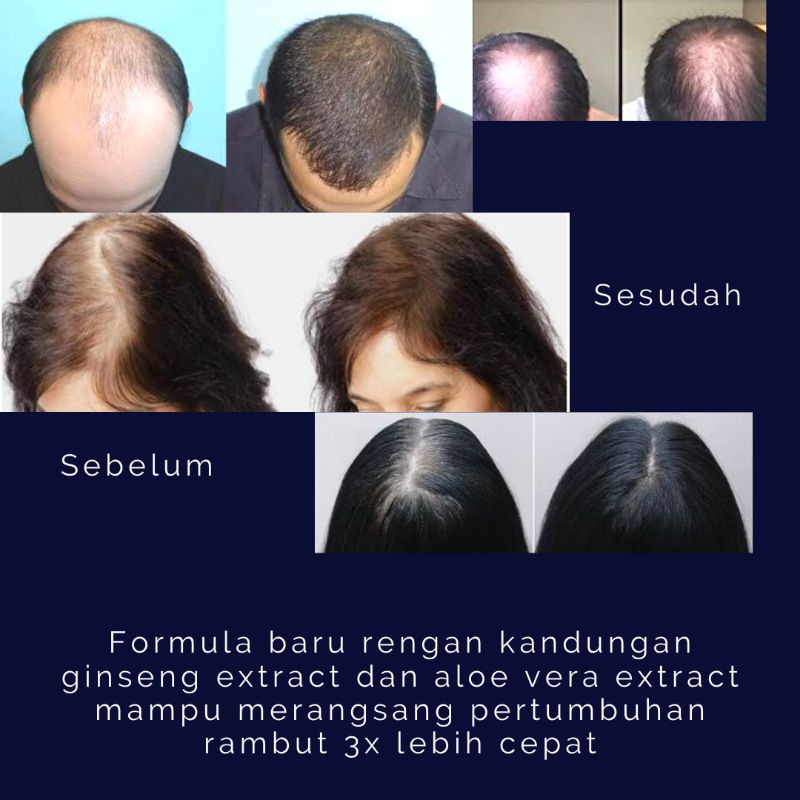 SERUM PENUMBUH RAMBUT ALAMI HAIR GROWTH SERUM SHEVANNA