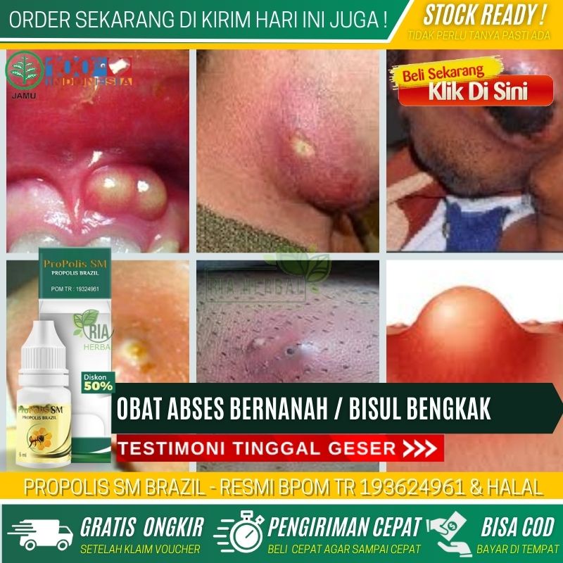 Obat Abses Gigi Untuk Anak dan Dewasa, Obat Abses Ambeien Bengkak, Abses Gusi Rahang Bawah Agar Peca