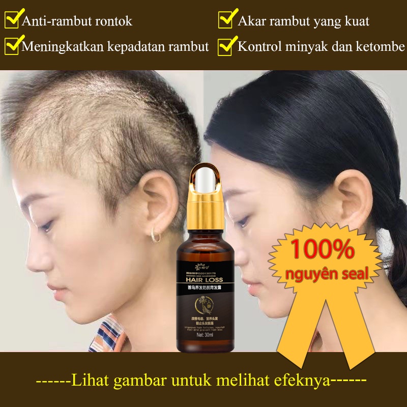 hair tonik 30ml penumbuh rambut/penumbuh rambut botak/serum penumbuh rambut/Memperbaiki folikel rambut/merangsang pertumbuhan rambut/perawatan rambut