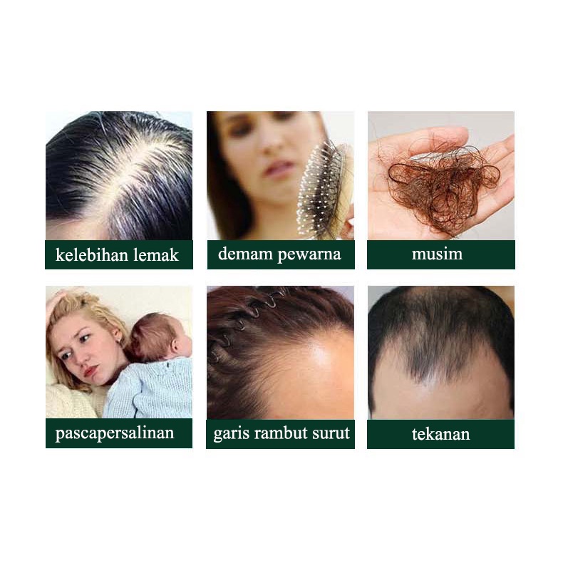 penumbuh rambut serum 30ml hair care Cepat dan efektif anti kebotakan/pertumbuhan rambut/perawatan kulit kepala/penebalan rambut