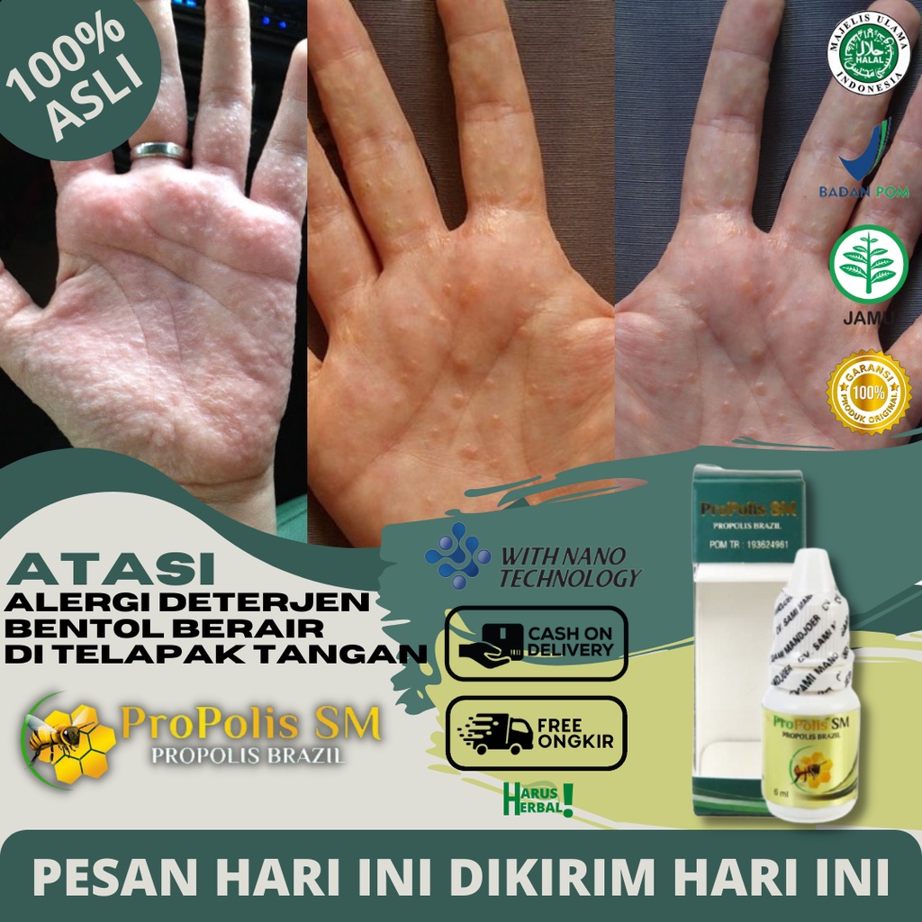 Jual Obat Alergi Telapak Tangan Bentol Berair Di Telapak Tangan Obat Alergi Deterjen Obat 9087