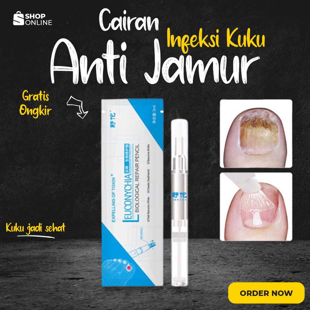 Cairan Infeksi Kuku Anti Jamur Untuk Kuku Kaki Rusak