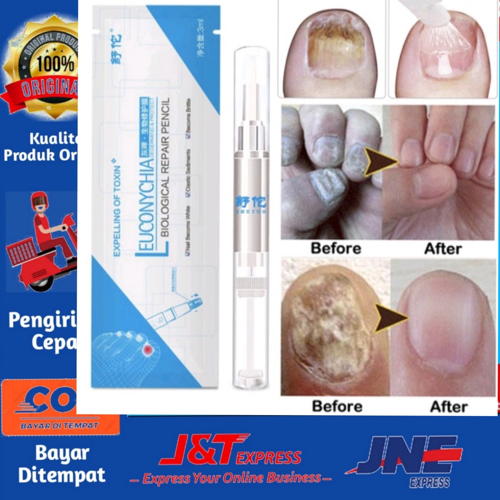 [BISA COD] Leuconychia Biological Repair Pencil Obat Anti Jamur Bakteri Kuku Rusak Perawatan Infeksi Kuku Sakit